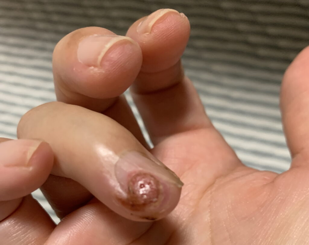 そのお悩み皮膚科ではなく ネイルで解消できるかも ニコルネイル Nail Nicol サロン スクール